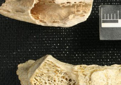 صورة تقارن بين عظم نياندرتال مصاب بالسرطان (الى الاعلى) وآخر سليم